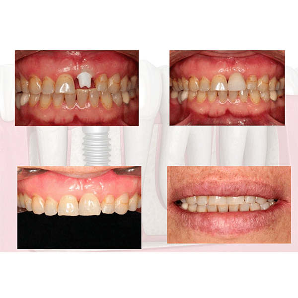 Implante dental de zirconio terminado - Dr. Parra