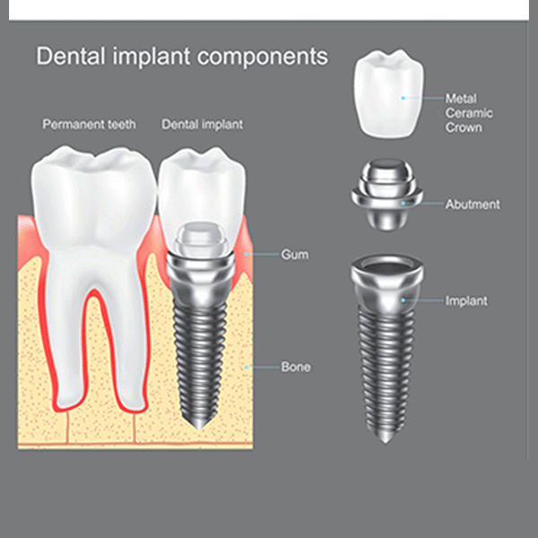 Rehabilitación completa sobre implantes - Dr. Parra