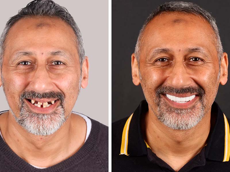 }
            antes y después
