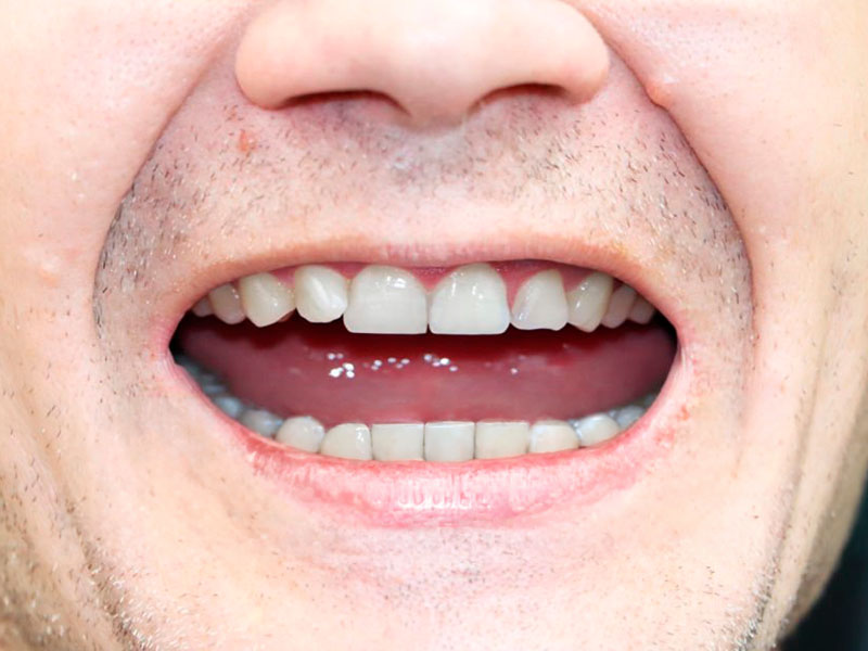 Implante dental