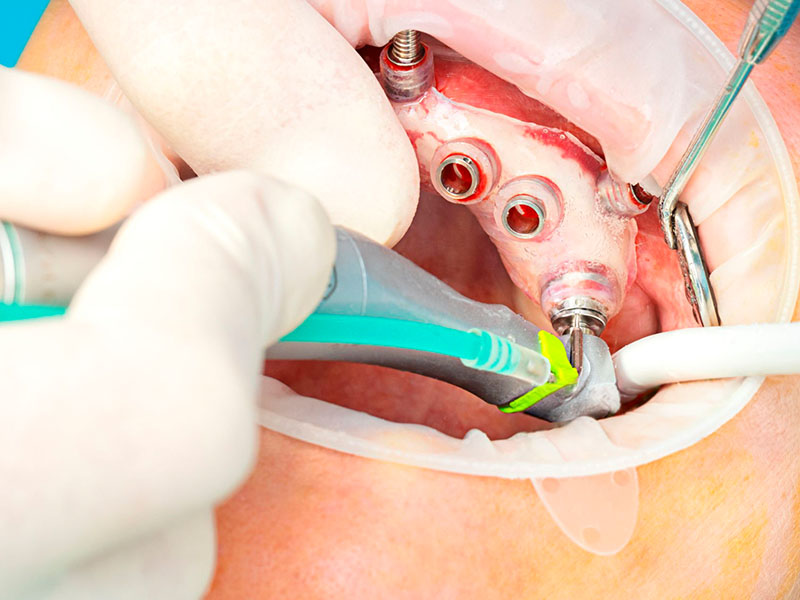 Implante Dental Colocación