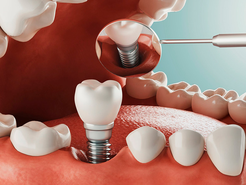 Falta de pieza dental - Antes